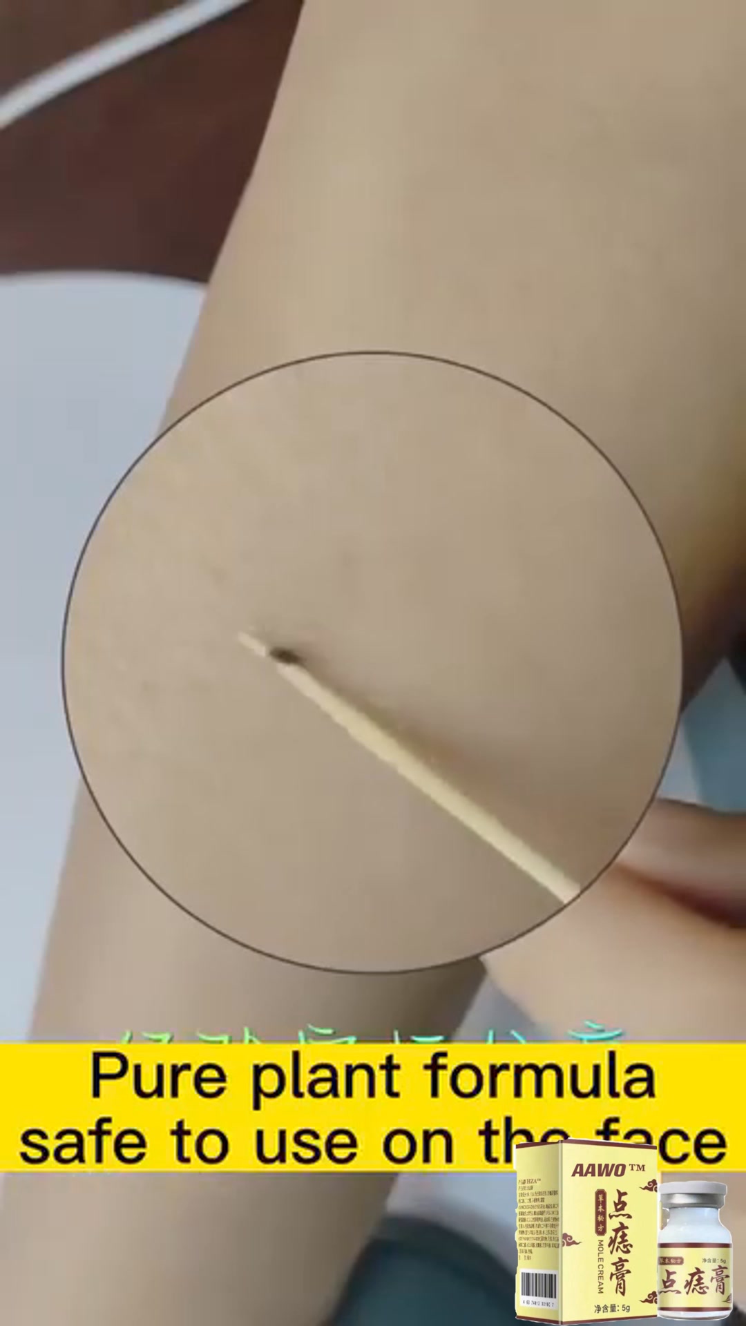 (🔥LAST DAY SALE-80% OFF) AAWO™ Concentrated potent skin tag removal c