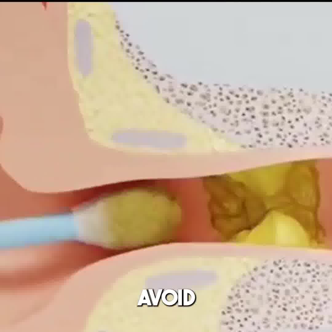 Tweddy - Smart Earwax Remover