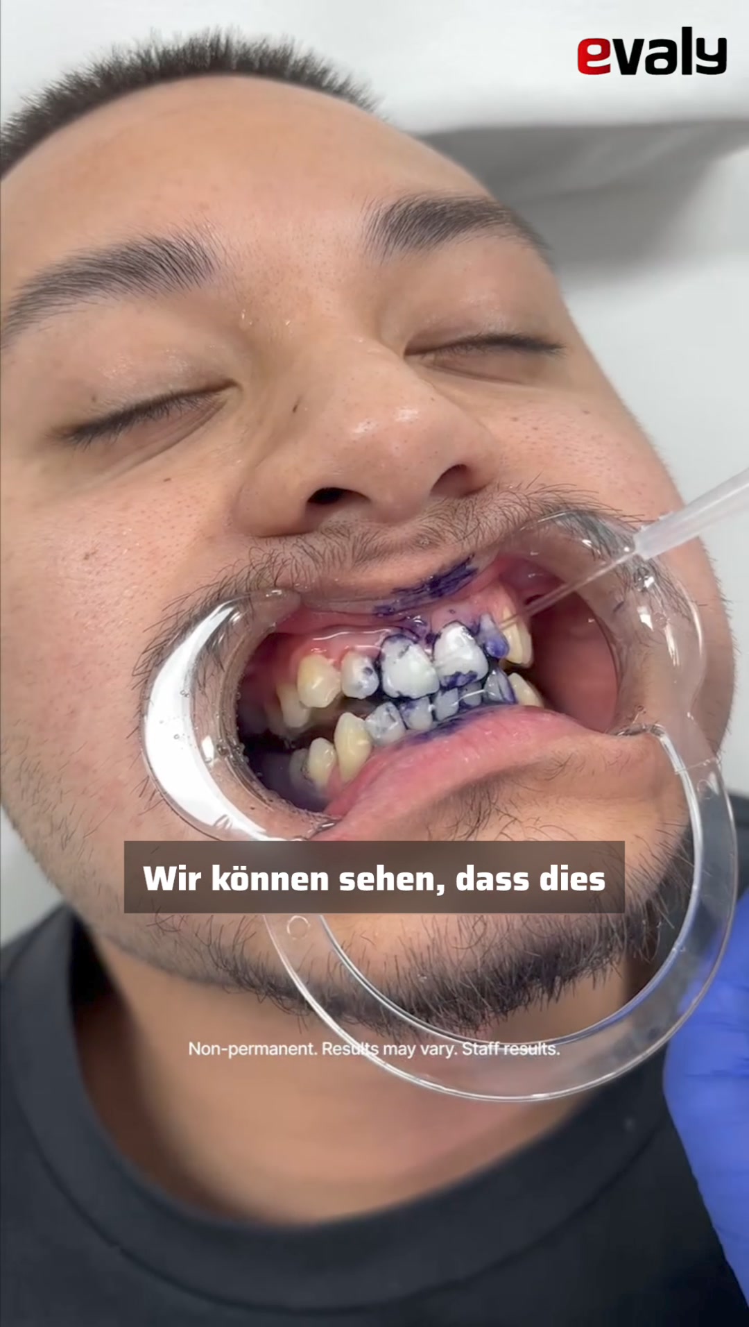 BrightSmile® - Zahnaufhellungspaste - Evaly ad creative