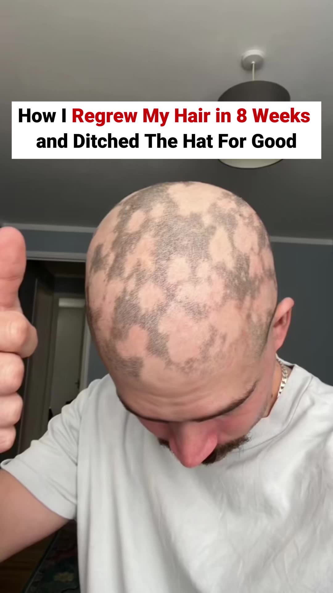 Alopecia Areata Rescue Kit For Men ad creative